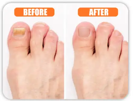 Hewelth BioClear before and after