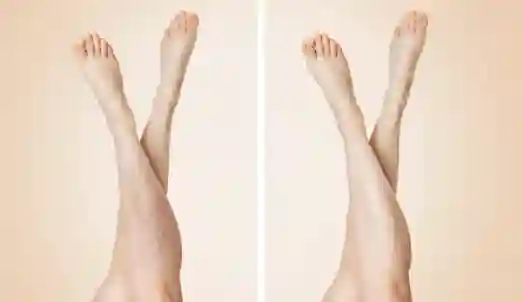 Leglief before and after